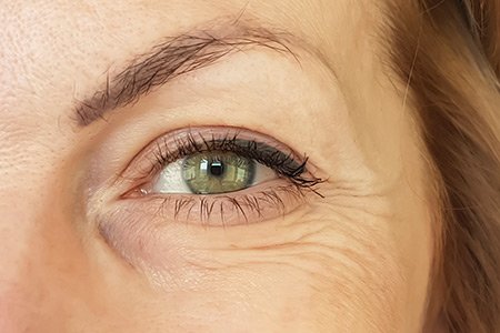 blepharoplasty